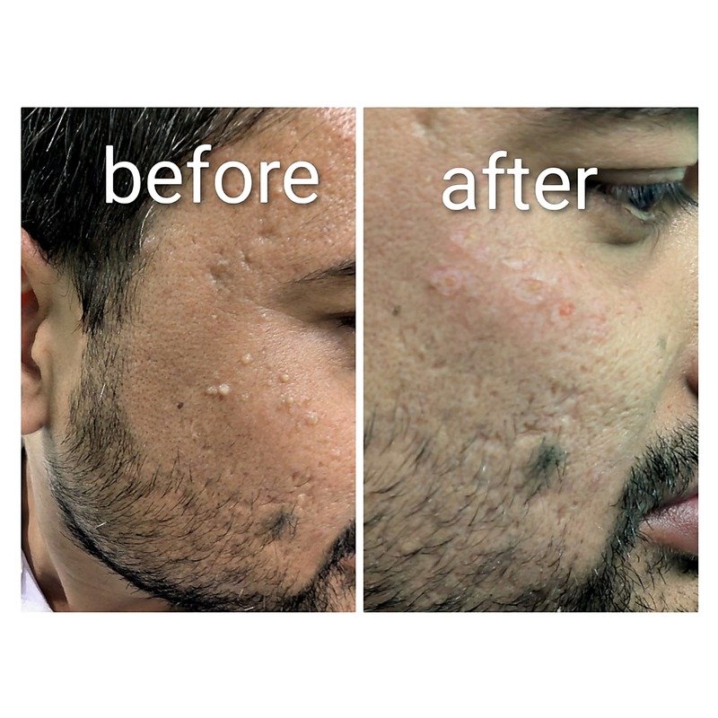 Before & After treatment result 1