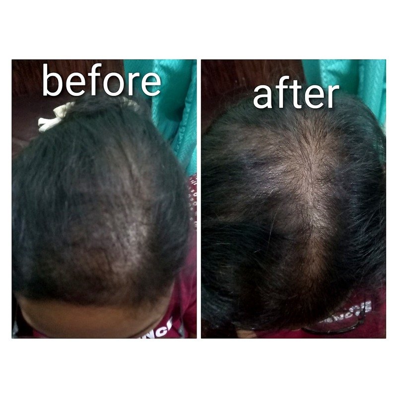 Before & After treatment result 2