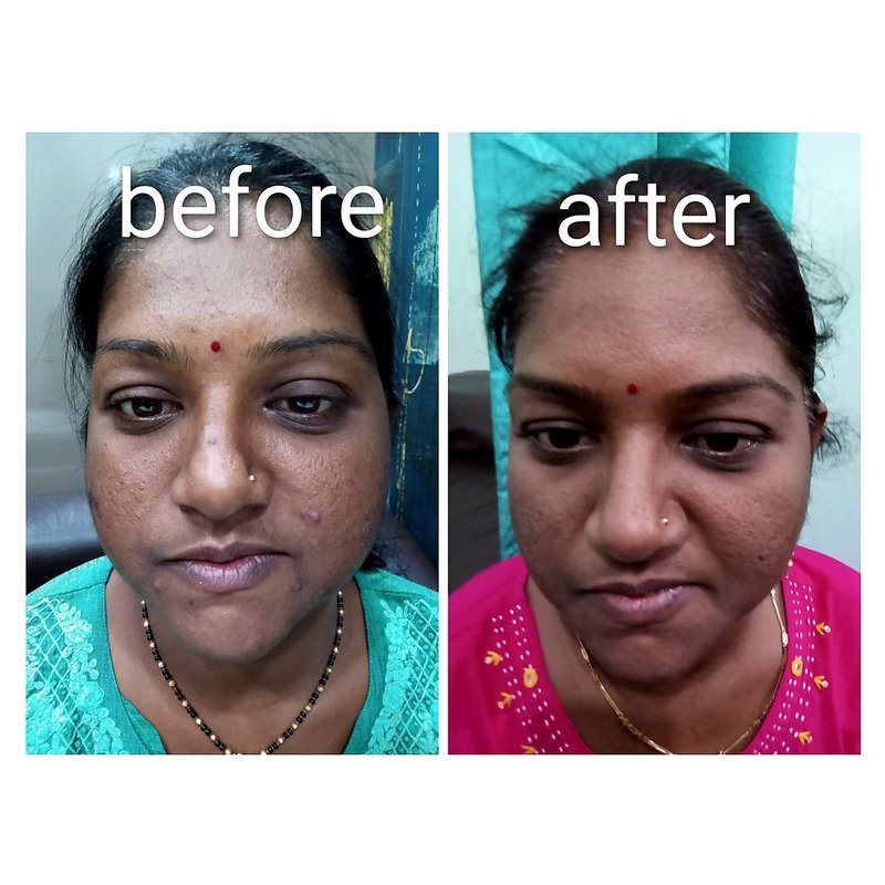 Before & After treatment result 6